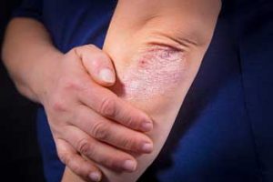 eczema flareup, natural eczema relief, treat eczema with essential oils, summertime eczema flareup