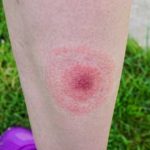 erythema migrans